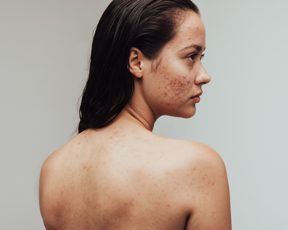 female with acne on back and shoulder showing skin issues and skincare concerns 3 effective treatments