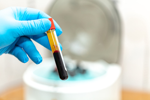 person wearing blue gloves holding a blood sample in a test tube with a red and yellow cap next to a centrifuge indicating medical testing in a laboratory context related to blood analysis and 15 procedures