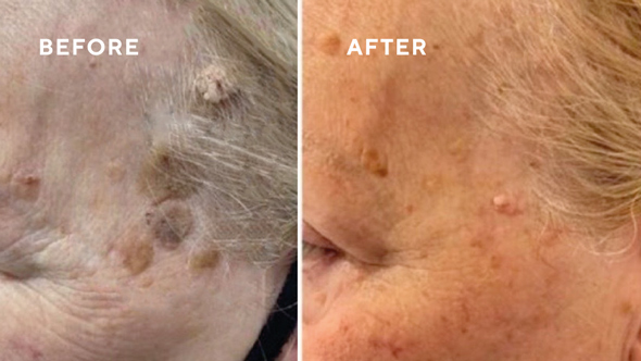 before and after skin treatment showing improvement in skin appearance 5 effective solutions for skin issues