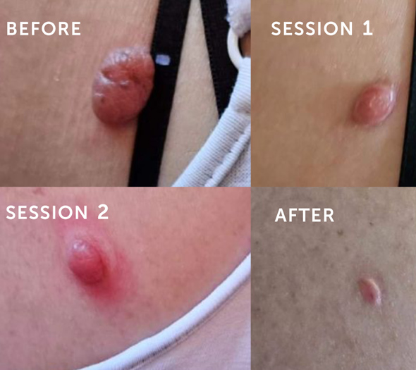 skin treatment progression with results after 4 sessions